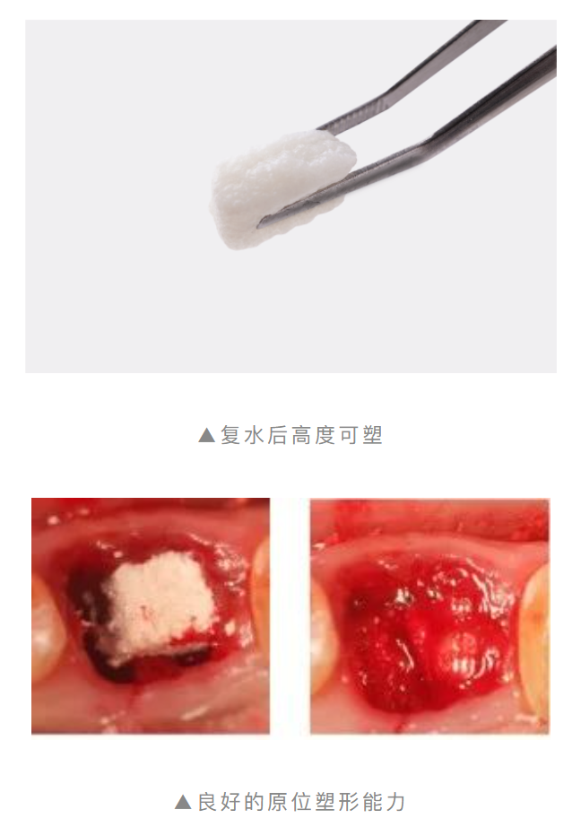 重磅上市！傲塑口腔颌骨骨再生产品 | 国内首款复合透明质酸天然骨填充材料