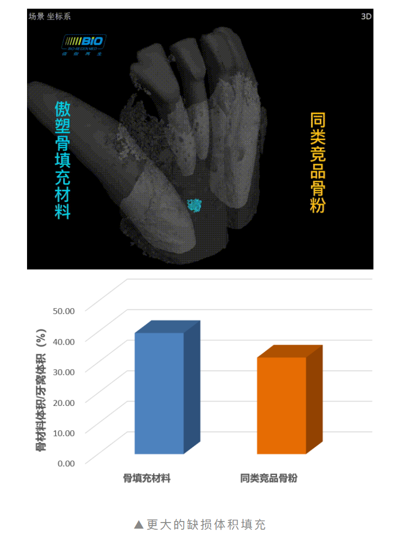 重磅上市！傲塑口腔颌骨骨再生产品 | 国内首款复合透明质酸天然骨填充材料